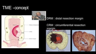 TME -concept
DRM : distal resection margin
CRM : circumferential resection
margin
T
N
 
