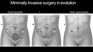 Minimally Invasive surgery inevolution
Hand-assisted +
Pfannenstiehl
Total Laparoscopic
 