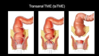 TransanalTME (taTME)
 