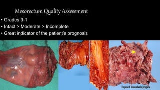 Mesorectum Quality Assessment
• Grades 3-1
• Intact > Moderate > Incomplete
• Great indicator of the patient’s prognosis
 