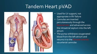 Mechanical Circulatory Support | PPTX