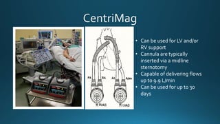Mechanical Circulatory Support | PPTX