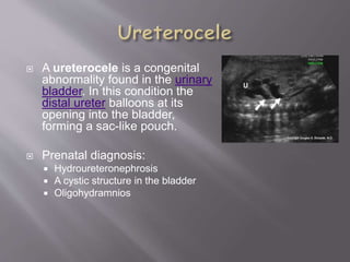  A ureterocele is a congenital
abnormality found in the urinary
bladder. In this condition the
distal ureter balloons at its
opening into the bladder,
forming a sac-like pouch.
 Prenatal diagnosis:
 Hydroureteronephrosis
 A cystic structure in the bladder
 Oligohydramnios
 