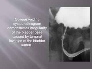 .
Oblique voiding
cystourethrogram
demonstrates irregularity
of the bladder base
caused by tumoral
invasion of the bladder
lumen .
 