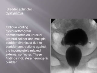 Bladder sphincter
dyssynergia.
Oblique voiding
cystourethrogram
demonstrates an unusual
urethral caliber and multiple
bladder diverticula due to
bladder contractions against
the incompletely relaxed
external sphincter. These
findings indicate a neurogenic
bladder.
 
