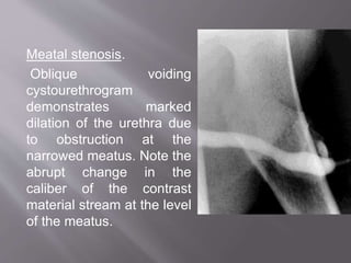 Meatal stenosis.
Oblique voiding
cystourethrogram
demonstrates marked
dilation of the urethra due
to obstruction at the
narrowed meatus. Note the
abrupt change in the
caliber of the contrast
material stream at the level
of the meatus.
 