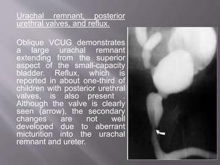 Urachal remnant, posterior
urethral valves, and reflux.
Oblique VCUG demonstrates
a large urachal remnant
extending from the superior
aspect of the small-capacity
bladder. Reflux, which is
reported in about one-third of
children with posterior urethral
valves, is also present .
Although the valve is clearly
seen (arrow), the secondary
changes are not well
developed due to aberrant
micturition into the urachal
remnant and ureter.
 