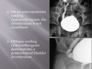  On an anteroposterior
voiding
cystourethrogram, the
diverticulum is not
visualized.
 Oblique voiding
cystourethrogram
demonstrates a
posterolateral bladder
diverticulum.
 