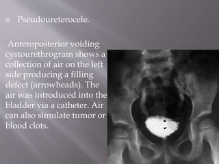  Pseudoureterocele.
Anteroposterior voiding
cystourethrogram shows a
collection of air on the left
side producing a filling
defect (arrowheads). The
air was introduced into the
bladder via a catheter. Air
can also simulate tumor or
blood clots.
 