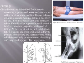 Filming:
Once the contrast is instilled, fluoroscopic
screening is performed to see vesicoureteraic
reflux or other abnormalities. Patient is turned
oblique to ensure minimal reflux is not over
looked. If reflux appears , oblique films are
taken. If the bladder appears normal, one film
is taken in frontal projection at the end of
filling. At the end of voiding a frontal film is
taken of entire abdomen including kidney to
prevent overlooking the vesicoureteric reflux
which is seen only on termination of voiding
and may reach upper collecting system.
 