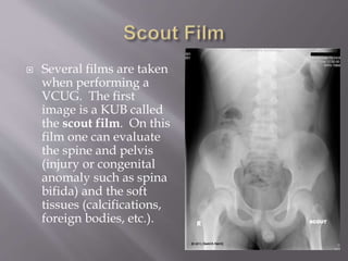  Several films are taken
when performing a
VCUG. The first
image is a KUB called
the scout film. On this
film one can evaluate
the spine and pelvis
(injury or congenital
anomaly such as spina
bifida) and the soft
tissues (calcifications,
foreign bodies, etc.).
 