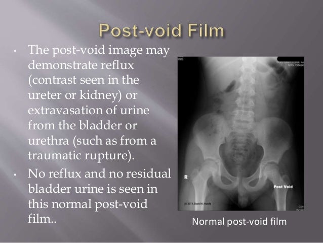 cpt code for post void residual bladder scan cpt code for post void residual bladder scan