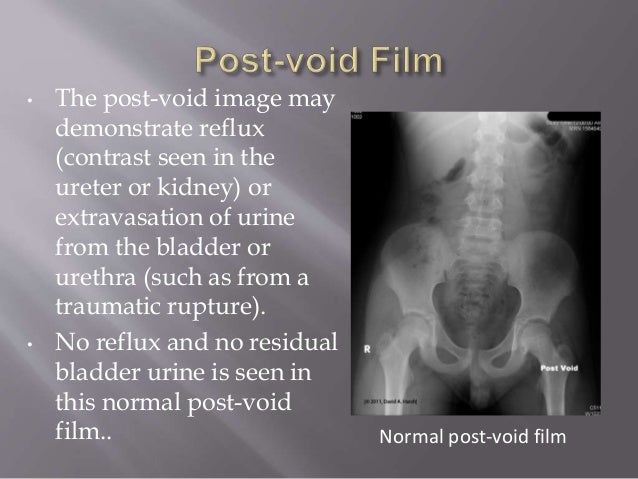 normal postvoid residual