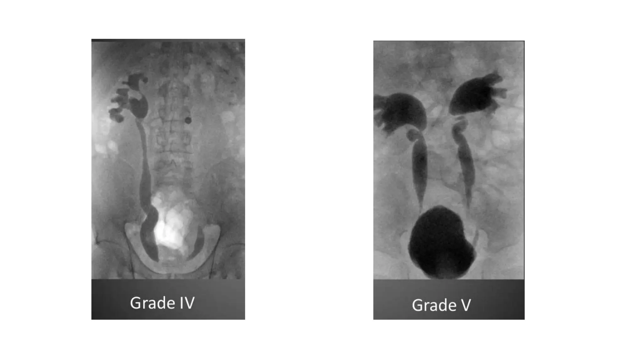 Utricular Cyst Rgu MCU AND RGU | PPTX