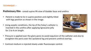 TECHINIQUE :-
Preliminary film - coned supine PA view of bladder base and urethra
• Patient is made to lie in supine position and slightly tilted
with legs position as shown in the image.
• Using aseptic conditions, the tip of the Foley's catheter is
inserted in the urethra after applying lignocaine jelly
for 2 to 4 cm length.
• Pressure is applied over the glans penis to avoid expulsion of the catheter and also to
straighten the penis over the ipsilateral leg and prevent urethral overlap.
• Contrast medium is injected slowly under fluoroscopic control.
 