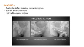 IMAGING:-
• Supine PA before injecting contrast medium.
• 30º left anterior oblique
• 30º right anterior oblique
 