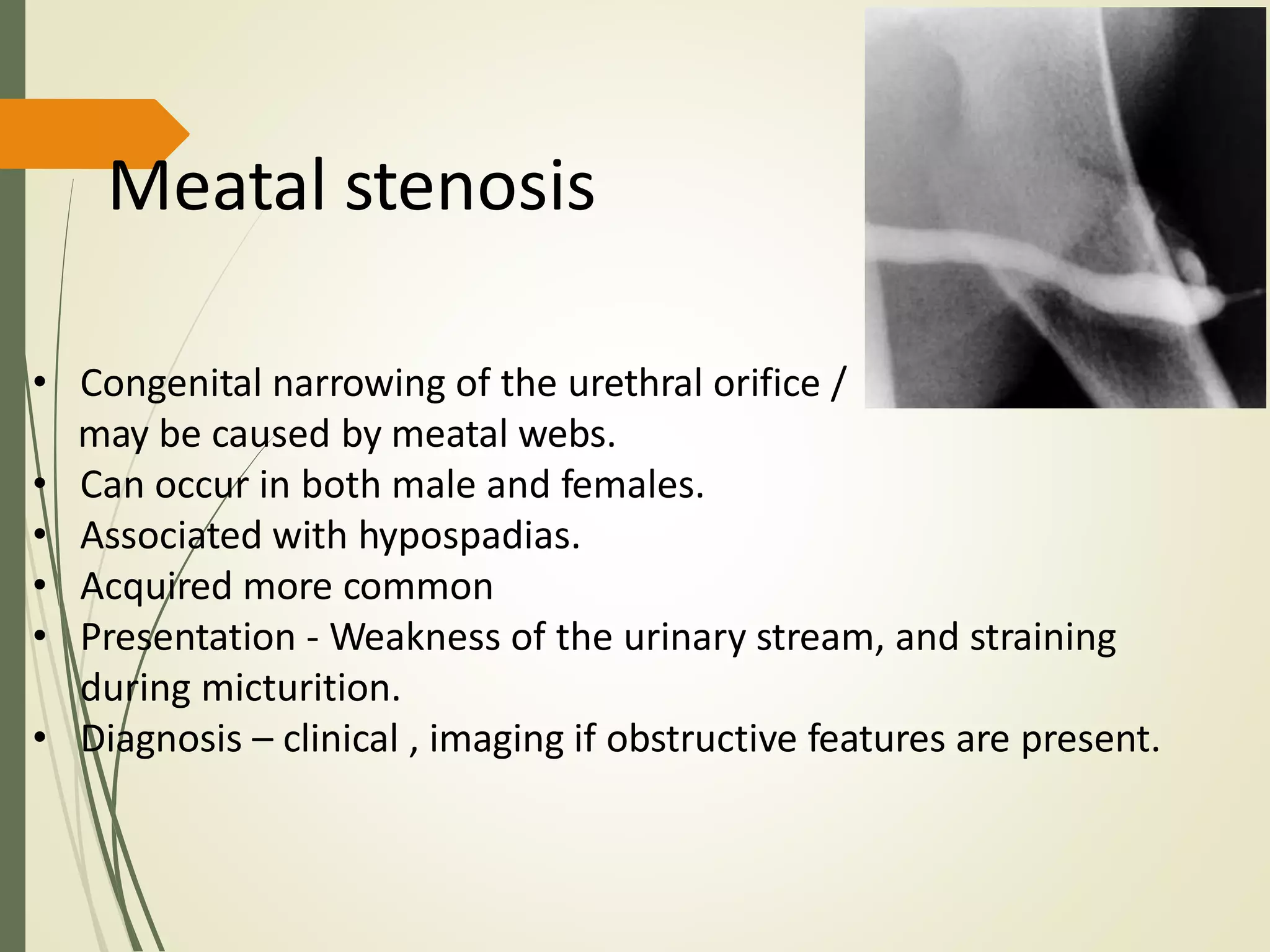 Meatal stenosis
• Congenital narrowing of the urethral orifice /
may be caused by meatal webs.
• Can occur in both male and females.
• Associated with hypospadias.
• Acquired more common
• Presentation - Weakness of the urinary stream, and straining
during micturition.
• Diagnosis – clinical , imaging if obstructive features are present.
 