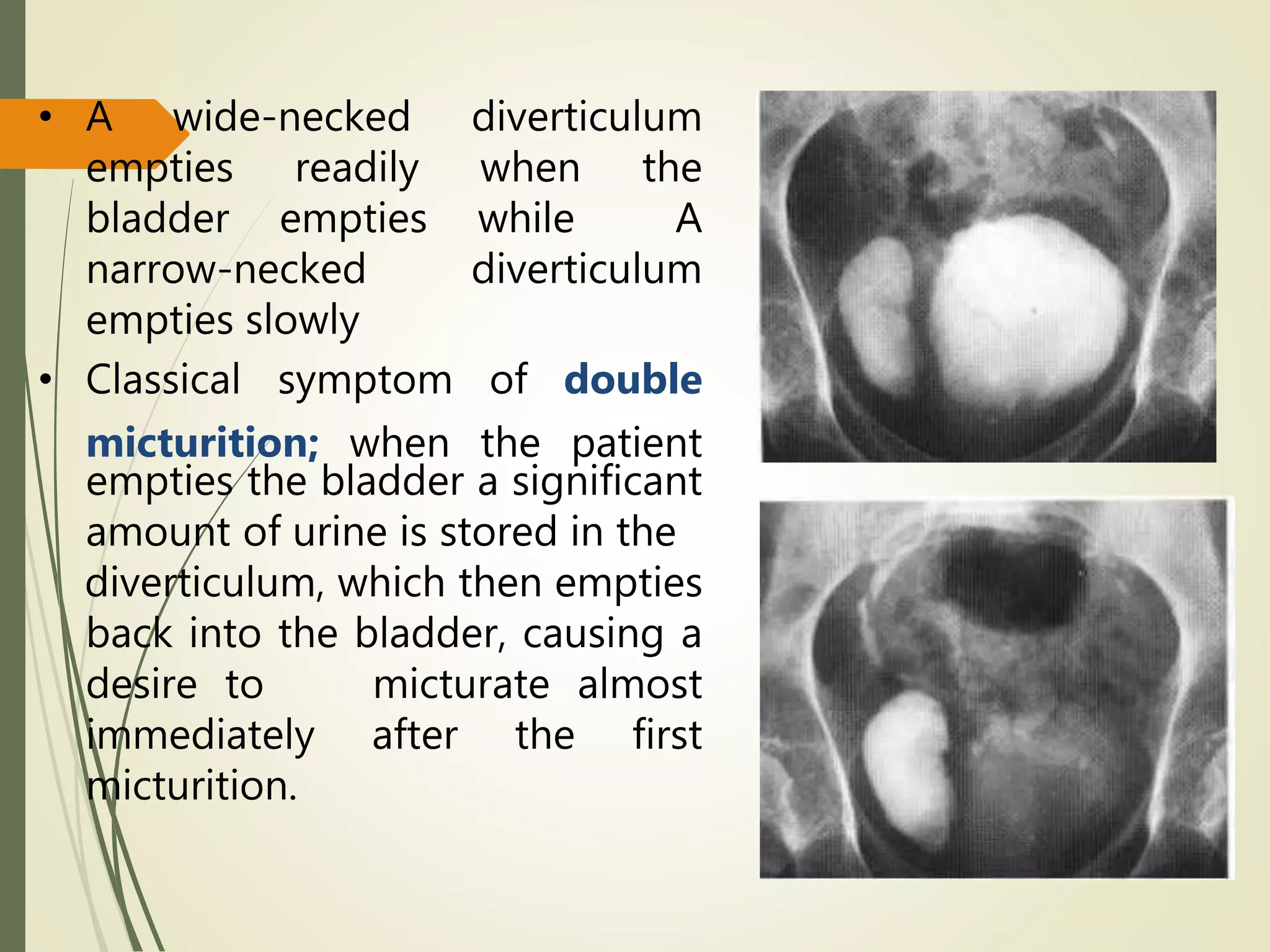 • A wide-necked diverticulum
empties readily when the
bladder empties while A
narrow-necked diverticulum
empties slowly
• Classical symptom of double
micturition; when the patient
empties the bladder a significant
amount of urine is stored in the
diverticulum, which then empties
back into the bladder, causing a
desire to micturate almost
immediately after the first
micturition.
 