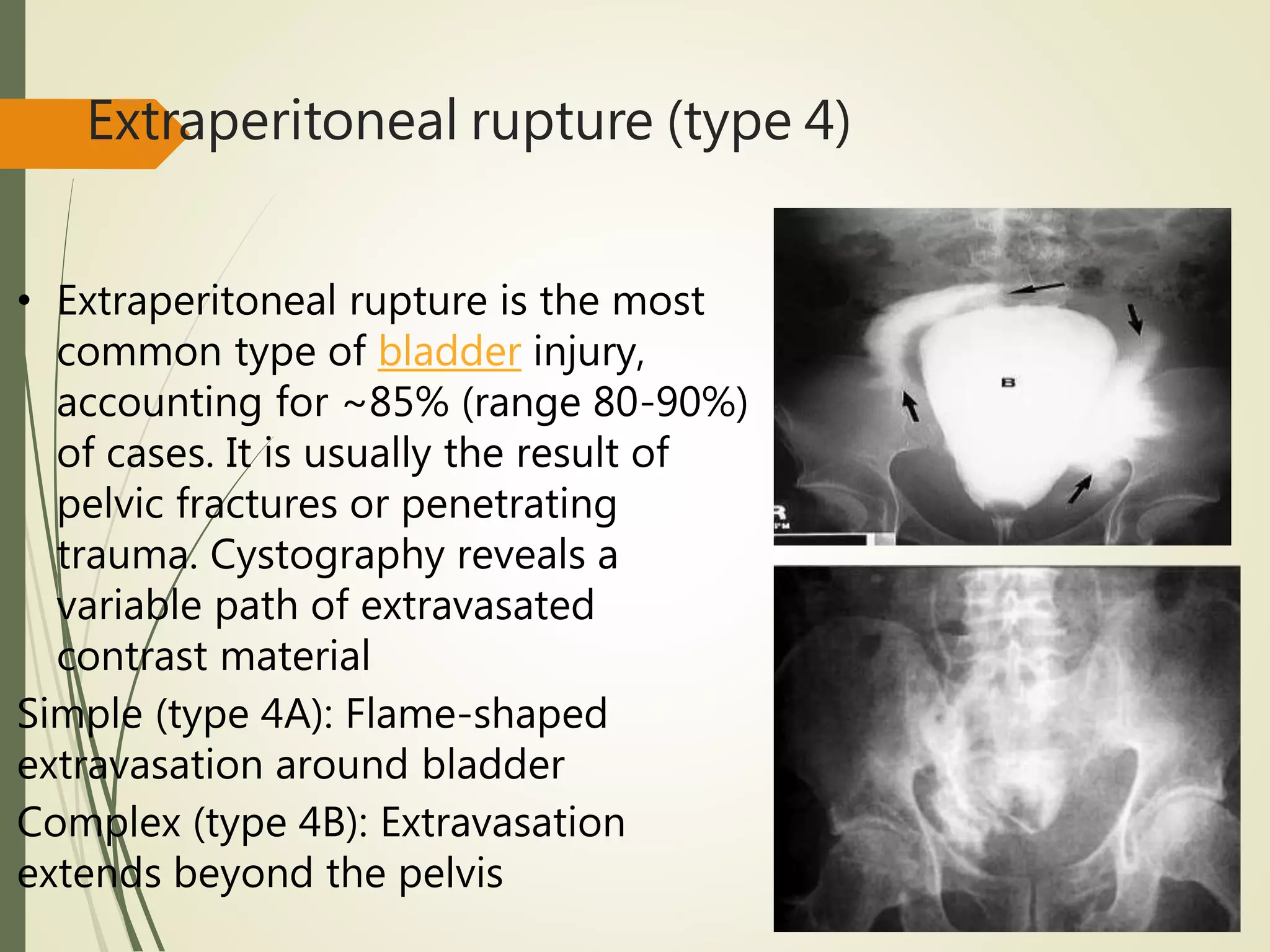 Extraperitoneal rupture (type 4)
• Extraperitoneal rupture is the most
common type of bladder injury,
accounting for ~85% (range 80-90%)
of cases. It is usually the result of
pelvic fractures or penetrating
trauma. Cystography reveals a
variable path of extravasated
contrast material
Simple (type 4A): Flame-shaped
extravasation around bladder
Complex (type 4B): Extravasation
extends beyond the pelvis
 