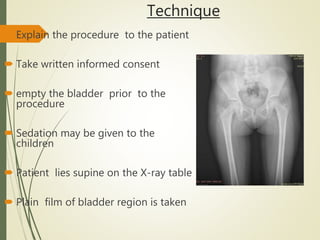 Technique
 Explain the procedure to the patient
 Take written informed consent
 empty the bladder prior to the
procedure
 Sedation may be given to the
children
 Patient lies supine on the X-ray table
 Plain film of bladder region is taken
 