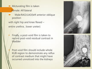  Micturating film is taken
Female: AP/lateral
 Male:RAO/LAO(left anterior oblique
position
with right hip and knee flexed –
entire urethra , lower ureter)
 Finally, a post-void film is taken to
record post-void residual contrast in
bladder
 Post-void film should include whole
KUB region to demonstrate any relfux
of contrast medium that might have
occurred unnoticed into the kidneys
 