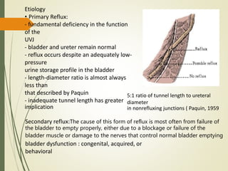 Etiology
• Primary Reflux:
- fundamental deficiency in the function
of the
UVJ
- bladder and ureter remain normal
- reflux occurs despite an adequately low-
pressure
urine storage profile in the bladder
- length-diameter ratio is almost always
less than
that described by Paquin
- inadequate tunnel length has greater
implication
5:1 ratio of tunnel length to ureteral
diameter
in nonrefluxing junctions ( Paquin, 1959
Secondary reflux:The cause of this form of reflux is most often from failure of
the bladder to empty properly, either due to a blockage or failure of the
bladder muscle or damage to the nerves that control normal bladder emptying
bladder dysfunction : congenital, acquired, or
behavioral
 