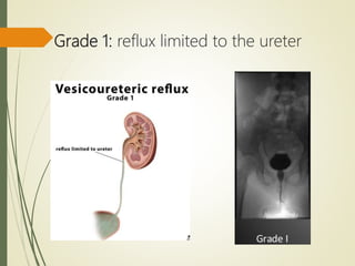 Grade 1: reflux limited to the ureter
 