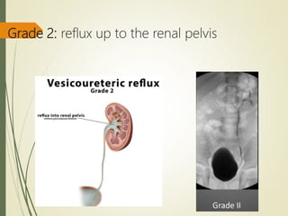 Grade 2: reflux up to the renal pelvis
 