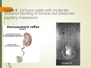 Grade 4 : tortuous ureter with moderate
dilatation blunting of fornices but preserved
papillary impressions
 