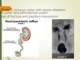 Grade 5: tortuous ureter with severe dilatation
of ureter and pelvicalyceal system
loss of fornices and papillary impressions.
 