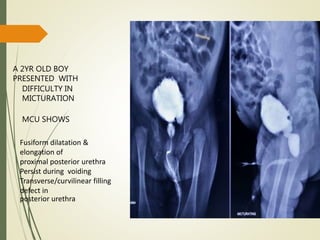 Fusiform dilatation &
elongation of
proximal posterior urethra
Persist during voiding
Transverse/curvilinear filling
defect in
posterior urethra
A 2YR OLD BOY
PRESENTED WITH
DIFFICULTY IN
MICTURATION
MCU SHOWS
 