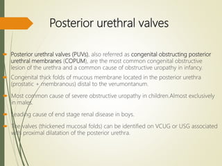 Posterior urethral valves
 Posterior urethral valves (PUVs), also referred as congenital obstructing posterior
urethral membranes (COPUM), are the most common congenital obstructive
lesion of the urethra and a common cause of obstructive uropathy in infancy.
 Congenital thick folds of mucous membrane located in the posterior urethra
(prostatic + membranous) distal to the verumontanum.
 Most common cause of severe obstructive uropathy in children.Almost exclusively
in males.
 Leading cause of end stage renal disease in boys.
 The valves (thickened mucosal folds) can be identified on VCUG or USG associated
with proximal dilatation of the posterior urethra.
 