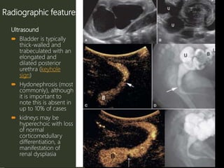 Radiographic features
Ultrasound
 Bladder is typically
thick-walled and
trabeculated with an
elongated and
dilated posterior
urethra (keyhole
sign)
 Hydonephrosis (most
commonly), although
it is important to
note this is absent in
up to 10% of cases
 kidneys may be
hyperechoic with loss
of normal
corticomedullary
differentiation, a
manifestation of
renal dysplasia
 