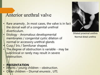Anterior urethral valve
• Rare anamoly , In most cases, the valve is in fact
the dorsal wall of a congenital urethral
diverticulum.
• Etiology - Anomalous developmental
membranes / congenital cystic dilation of
normal or accessory urethral glands
• Cusp / Iris / Semilunar shaped.
• The degree of obstruction is variable - may be
subclinical or rarely may result in severe
obstruction.
• PRESENTATION
• Infants / young children – obstruction.
• Older children – Diurnal enuresis , UTI.
Dilated proximal urethra
Normal distal urethra
AUV
 