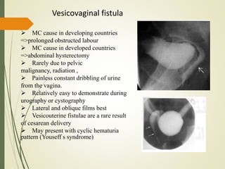  MC cause in developing countries
=>prolonged obstructed labour
 MC cause in developed countries
=>abdominal hysterectomy
 Rarely due to pelvic
malignancy, radiation ,
 Painless constant dribbling of urine
from the vagina.
 Relatively easy to demonstrate during
urography or cystography
 Lateral and oblique films best
 Vesicouterine fistulae are a rare result
of cesarean delivery
 May present with cyclic hematuria
pattern (Youseff s syndrome)
Vesicovaginal fistula
 