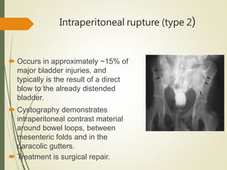 Intraperitoneal rupture (type 2)
 Occurs in approximately ~15% of
major bladder injuries, and
typically is the result of a direct
blow to the already distended
bladder.
 Cystography demonstrates
intraperitoneal contrast material
around bowel loops, between
mesenteric folds and in the
paracolic gutters.
 Treatment is surgical repair.
 