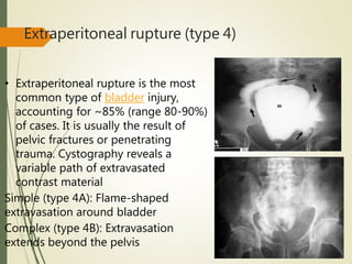 Extraperitoneal rupture (type 4)
• Extraperitoneal rupture is the most
common type of bladder injury,
accounting for ~85% (range 80-90%)
of cases. It is usually the result of
pelvic fractures or penetrating
trauma. Cystography reveals a
variable path of extravasated
contrast material
Simple (type 4A): Flame-shaped
extravasation around bladder
Complex (type 4B): Extravasation
extends beyond the pelvis
 