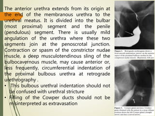 The anterior urethra extends from its origin at
the end of the membranous urethra to the
urethral meatus. It is divided into the bulbar
(most proximal) segment and the penile
(pendulous) segment. There is usually mild
angulation of the urethra where these two
segments join at the penoscrotal junction.
Contraction or spasm of the constrictor nudae
muscle, a deep musculotendinous sling of the
bulbocavernous muscle, may cause anterior or,
less frequently, circumferential indentation of
the proximal bulbous urethra at retrograde
urethrography .
• This bulbous urethral indentation should not
be confused with urethral stricture
• Filling of the Cowper ducts should not be
misinterpreted as extravasation
 