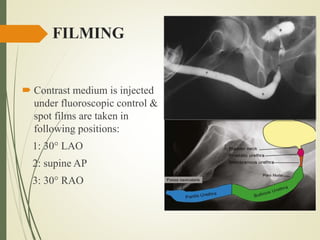 FILMING
 Contrast medium is injected
under fluoroscopic control &
spot films are taken in
following positions:
1: 30° LAO
2: supine AP
3: 30° RAO
 