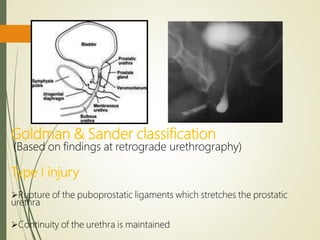 Goldman & Sander classification
(Based on findings at retrograde urethrography)
Type I injury
Rupture of the puboprostatic ligaments which stretches the prostatic
urethra
Continuity of the urethra is maintained
 
