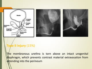 Type II injury (15%)
The membranous urethra is torn above an intact urogenital
diaphragm, which prevents contrast material extravasation from
extending into the perineum
 