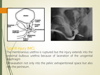 Type III injury (MC)
The membranous urethra is ruptured but the injury extends into the
proximal bulbous urethra because of laceration of the urogenital
diaphragm
Extravasation not only into the pelvic extraperitoneal space but also
into the perineum.
 