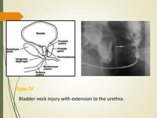 • Type IV
Bladder neck injury with extension to the urethra.
 