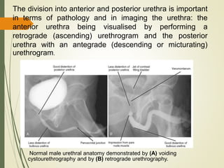 The division into anterior and posterior urethra is important
in terms of pathology and in imaging the urethra: the
anterior urethra being visualised by performing a
retrograde (ascending) urethrogram and the posterior
urethra with an antegrade (descending or micturating)
urethrogram.
Normal male urethral anatomy demonstrated by (A) voiding
cystourethrography and by (B) retrograde urethrography.
 
