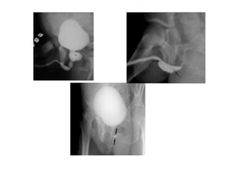 Utricular Cyst Rgu RGU (Retrograde urethrogram), MCU (Micturating cystourethrogram) and ...