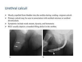 Utricular Cyst Rgu RGU (Retrograde urethrogram), MCU (Micturating cystourethrogram) and ...