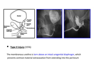 Utricular Cyst Rgu RGU (Retrograde urethrogram), MCU (Micturating cystourethrogram) and ...