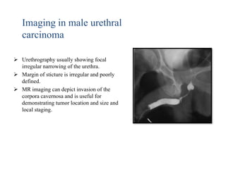 Utricular Cyst Rgu RGU (Retrograde urethrogram), MCU (Micturating cystourethrogram) and ...