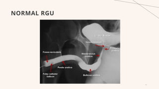 Utricular Cyst Rgu MCU, RGU and their interpretation in abnormalities of urinary bladder ...