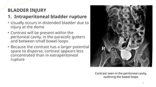 MCU, RGU and their interpretation in abnormalities of urinary bladder ...